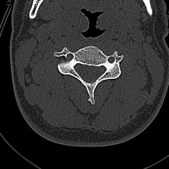 File:Normal CT of the cervical spine (Radiopaedia 53322-59305 Axial bone window 111).jpg