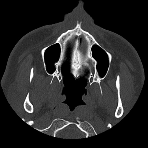 Normal CT paranasal sinuses (Radiopaedia 42286-45390 Axial bone window 91).jpg