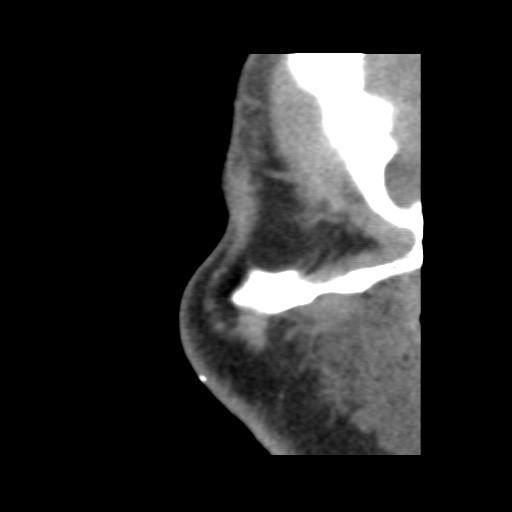 Normal CT paranasal sinuses (Radiopaedia 42286-45390 F 17).jpg