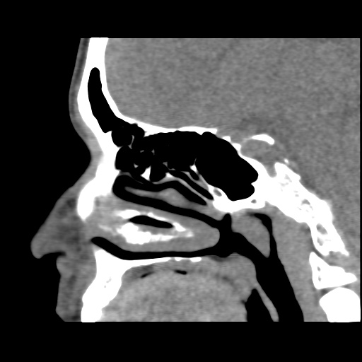 Normal CT paranasal sinuses (Radiopaedia 42286-45390 F 67).jpg
