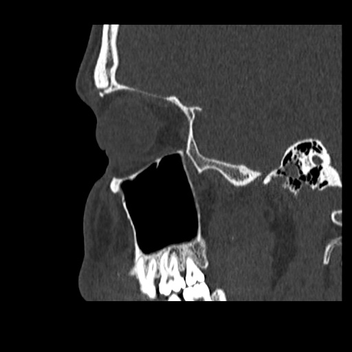 Normal CT paranasal sinuses (Radiopaedia 42286-45390 Sagittal bone window 23).jpg