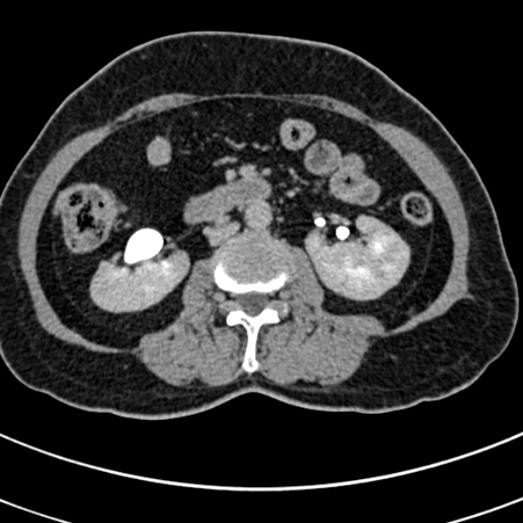 File:Normal CT split bolus study of the renal tract (Radiopaedia 48631-53634 Axial split bolus 107).jpg