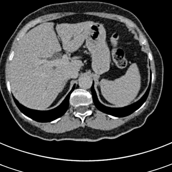 File:Normal CT split bolus study of the renal tract (Radiopaedia 48631-53634 Axial split bolus 4).jpg