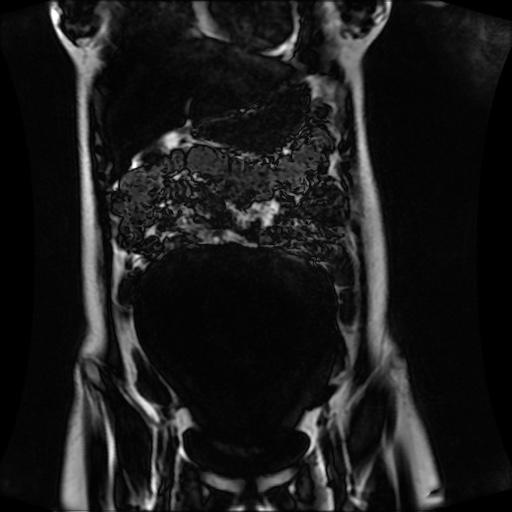 Normal MRI abdomen in pregnancy (Radiopaedia 88001-104541 N 47).jpg