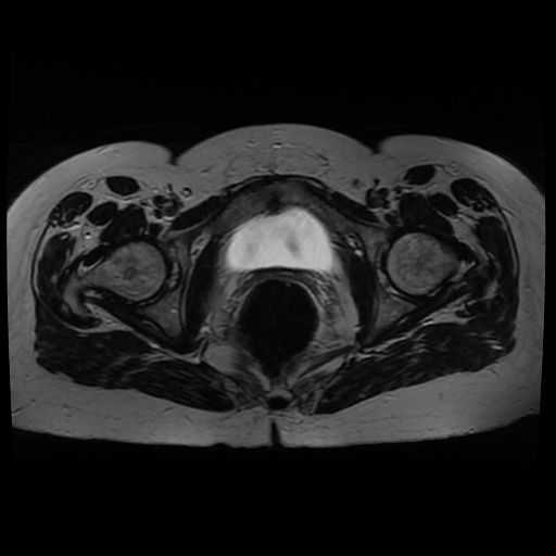 Normal MRI abdomen in pregnancy (Radiopaedia 88005-104548 Axial T2 42).jpg
