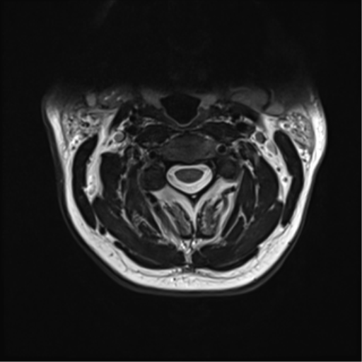 File:Normal MRI cervical spine (infection protocol) (Radiopaedia 53916-60039 Axial T2 18).png