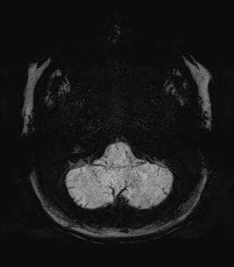 Normal MRI internal auditory canal (Radiopaedia 41613-44525 Axial SWI MIP 10).png