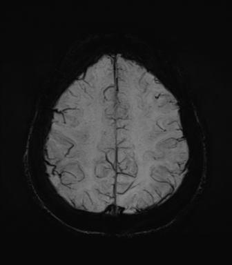 Normal MRI internal auditory canal (Radiopaedia 41613-44525 Axial SWI MIP 62).png