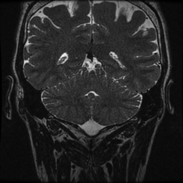 Normal MRI petrous (Radiopaedia 91317-108949 Coronal T2 97).jpg