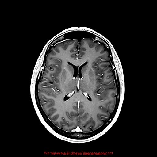 Normal adult brain MRI (non-enhanced and contrast-enhanced) (Radiopaedia 75262-86379 Axial T1 C+ 114).jpg