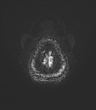 Normal brain MRI (TLE protocol) (Radiopaedia 40748-43405 Axial SWI 87).png