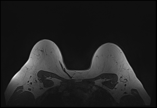 File:Normal breast MRI - dense breasts (Radiopaedia 80454-93850 Axial T1 187).jpg