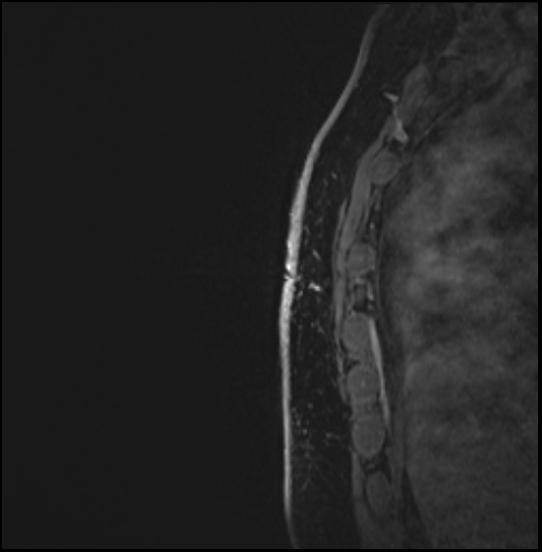 Normal breast MRI - dense breasts (Radiopaedia 80454-93850 I 167).jpg