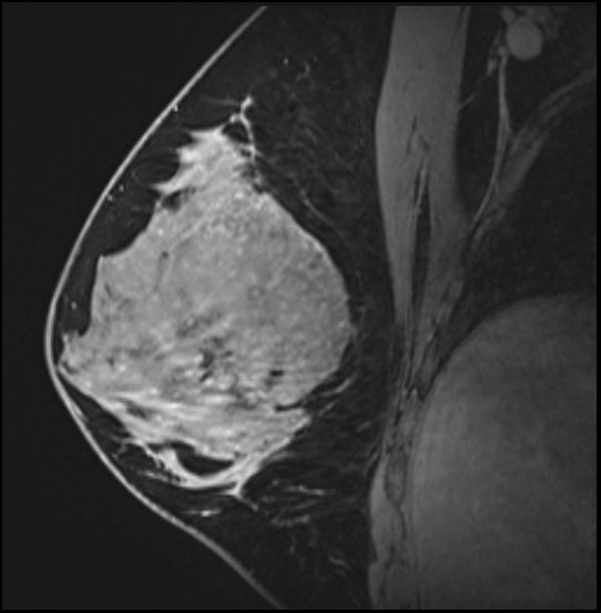 Normal breast MRI - dense breasts (Radiopaedia 80454-93850 I 84).jpg