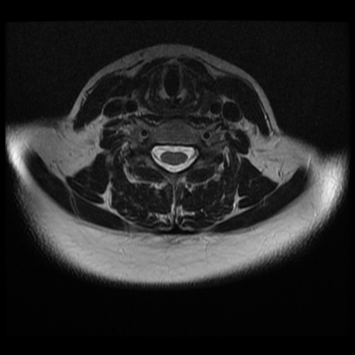 File:Normal cervical and thoracic spine MRI (Radiopaedia 35630-37156 Axial T2 15).png