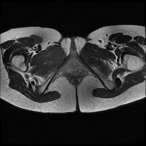 File:Normal female pelvis MRI (retroverted uterus) (Radiopaedia 61832-69933 Axial T2 29).jpg
