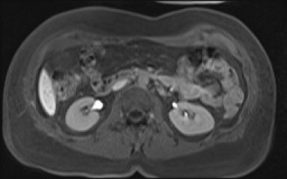 File:Normal hepatobiliary phase liver MRI (Radiopaedia 58968-66230 A 67).jpg