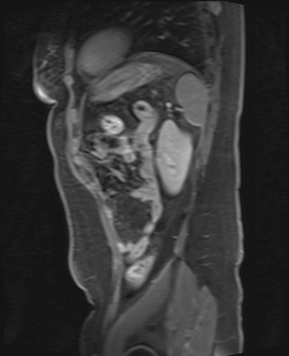 File:Normal hepatobiliary phase liver MRI (Radiopaedia 58968-66230 C 63).jpg