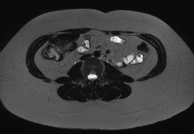 File:Normal liver MRI with Gadolinium (Radiopaedia 58913-66163 E 2).jpg