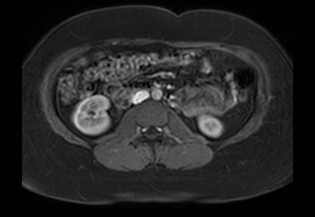 Normal liver MRI with Gadolinium (Radiopaedia 58913-66163 J 7).jpg