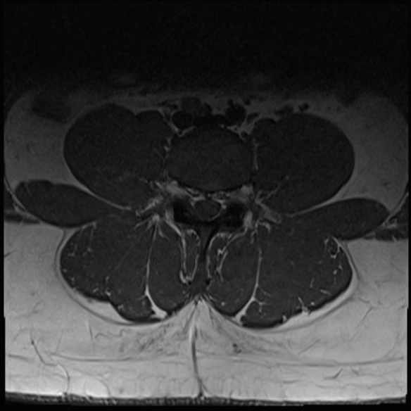 File:Normal lumbar spine MRI (Radiopaedia 47857-52609 Axial T1 14).jpg