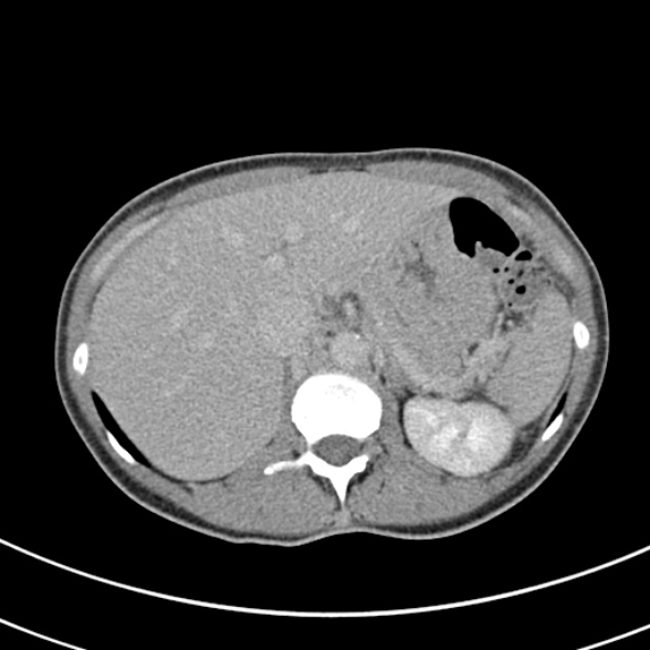 File:Normal multiphase CT liver (Radiopaedia 38026-39996 Axial C+ delayed 20).jpg