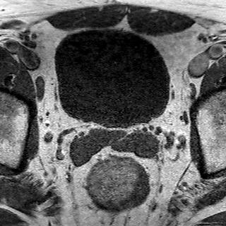 File:Normal prostate (MRI) (Radiopaedia 29986-30535 Axial T1 21).jpg