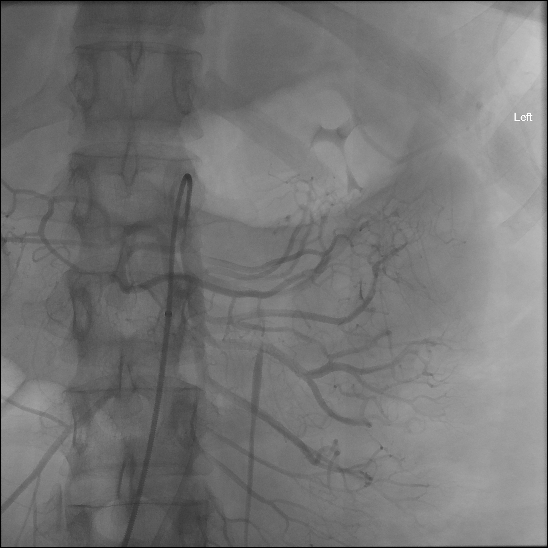 File:Normal superior mesenteric artery angiogram (Radiopaedia 77416).jpg
