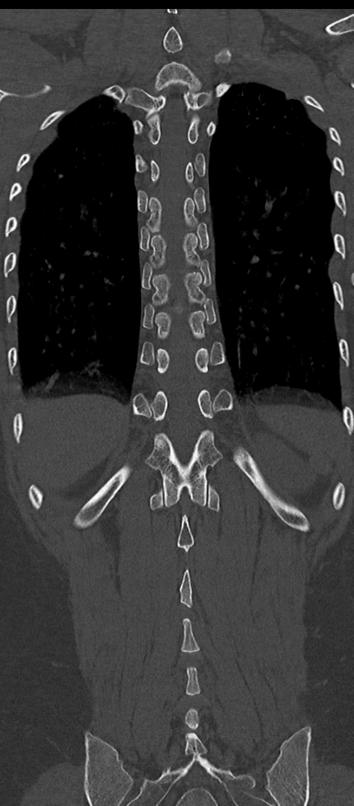 Normal thoracolumbar spine (Radiopaedia 43822-47309 Coronal bone window 68).png