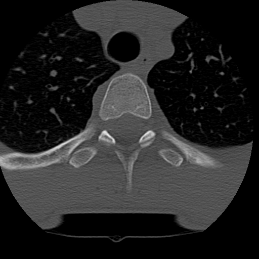 Normal trauma spine imaging (age 16) (Radiopaedia 45335-49358 Axial bone window 94).jpg
