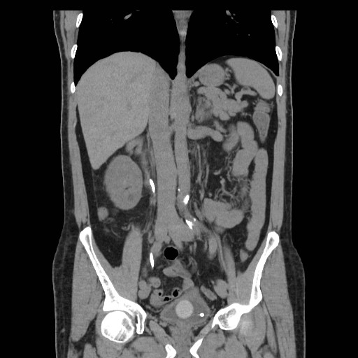 File:Obstructed kidney with perinephric urinoma (Radiopaedia 26889-27067 Coronal non-contrast 7).jpg