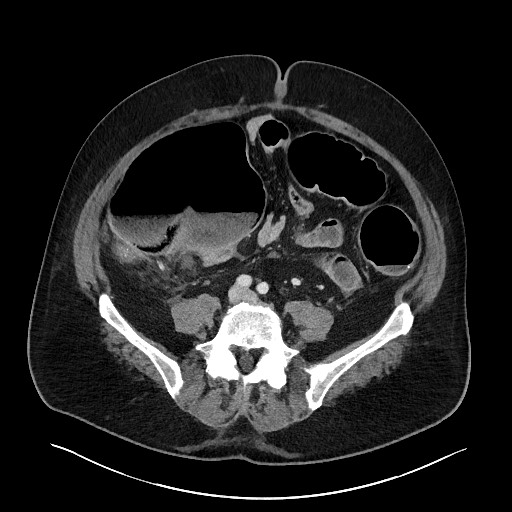 Obstructing sigmoid adenocarcinoma (Radiopaedia 58465-65619 A 110).jpg