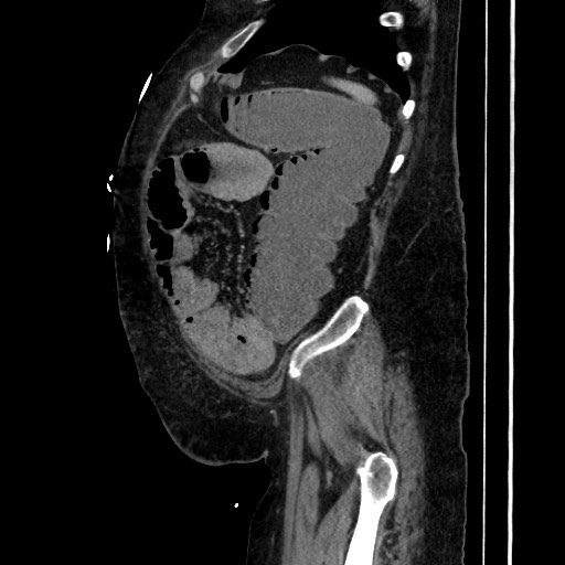 Obstructive colonic diverticular stricture (Radiopaedia 81085-94675 C 192).jpg