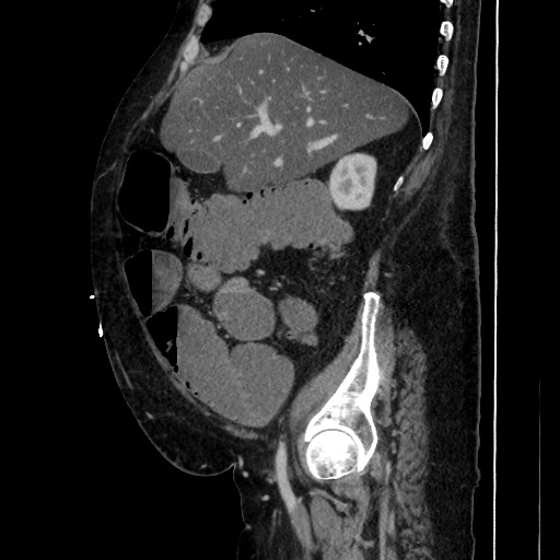 Obstructive colonic diverticular stricture (Radiopaedia 81085-94675 C 81).jpg