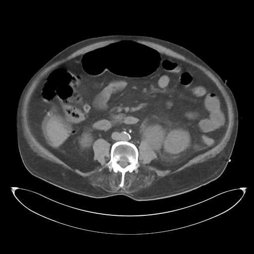 File:Obstructive pyelonephritis (Radiopaedia 46411-50844 Axial non-contrast 43).png