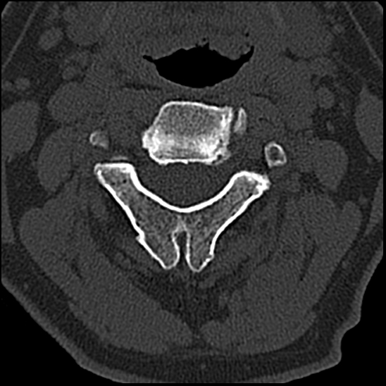 Occipital condyle fracture (type 1) (Radiopaedia 87670-104084 Axial bone window 32).jpg