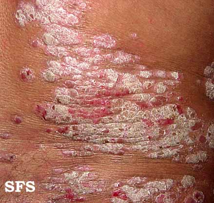 File:Psoriasis (Dermatology Atlas 15).jpg