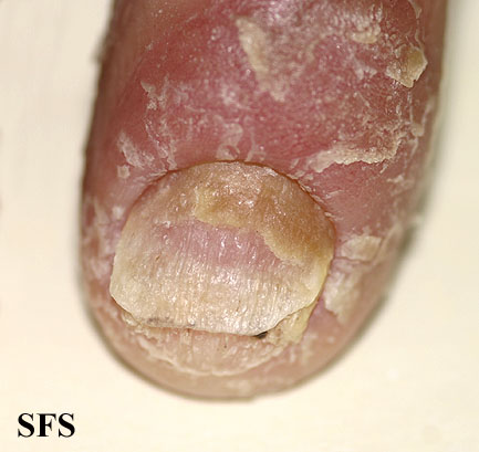 File:Psoriasis (Dermatology Atlas 41).jpg