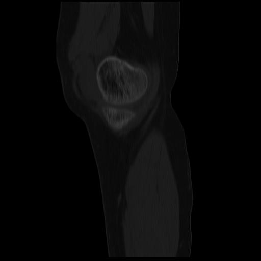 File:ACL avulsion fracture (Radiopaedia 33833-34994 Sagittal bone window 38).jpg