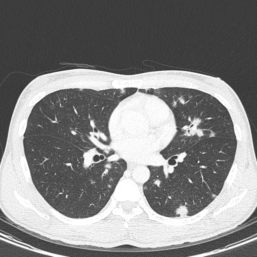 AIDS-related Kaposi sarcoma (Radiopaedia 85247-100811 Axial lung window 91).jpg