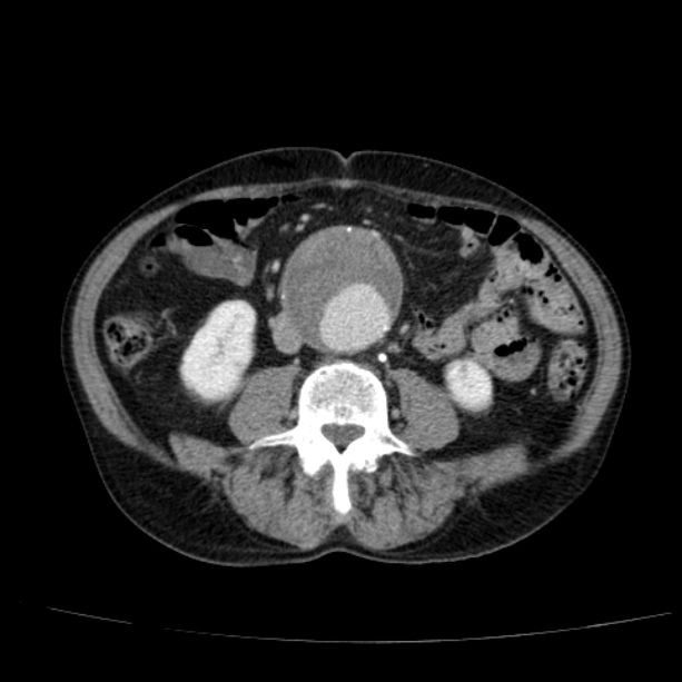Abdominal aortic aneurysm (Radiopaedia 29248-29660 Axial C+ portal venous phase 34).jpg
