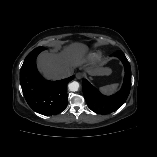 File:Abdominal aortic aneurysm (Radiopaedia 57318-64259 Axial C+ arterial phase 7).jpg