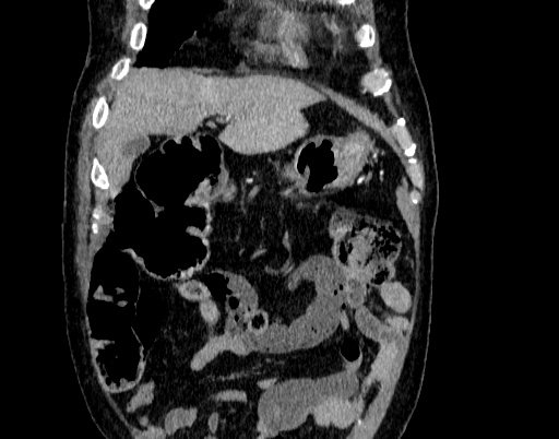 File:Abdominal aortic aneurysm (Radiopaedia 67117-76452 Coronal C+ arterial phase 3).jpg