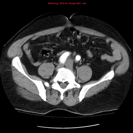 Abdominal aortic aneurysm (Radiopaedia 8190-9038 Axial C+ arterial phase 56).jpg
