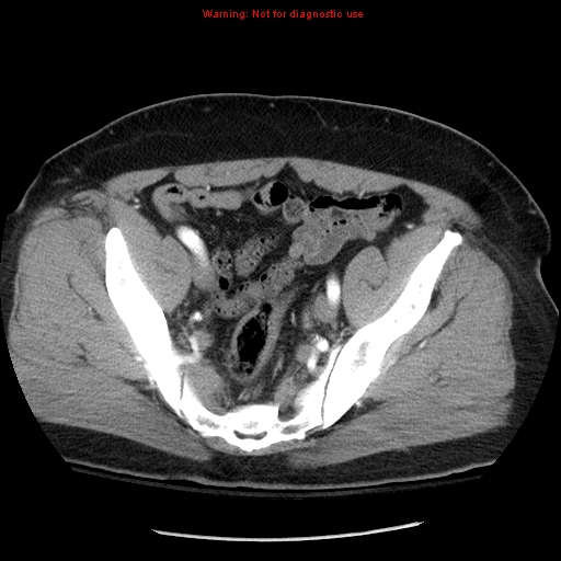 Abdominal aortic aneurysm (Radiopaedia 8190-9038 Axial C+ arterial phase 69).jpg