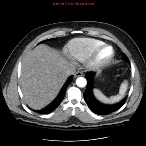 Abdominal aortic aneurysm (Radiopaedia 8190-9038 Axial C+ arterial phase 8).jpg