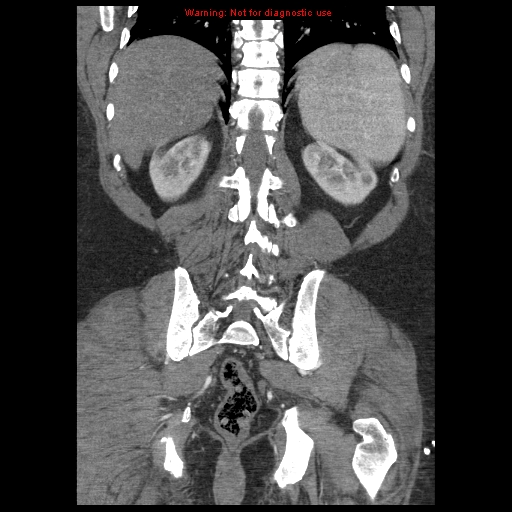 Abdominal aortic aneurysm (Radiopaedia 8190-9038 Coronal C+ arterial phase 99).jpg