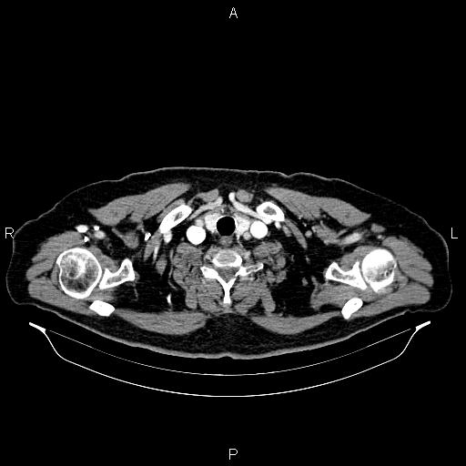 File:Abdominal aortic aneurysm (Radiopaedia 83094-97462 Axial renal cortical phase 3).jpg