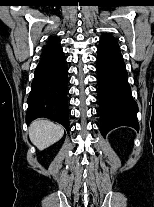 Abdominal aortic aneurysm (Radiopaedia 83094-97462 Coronal renal cortical phase 75).jpg