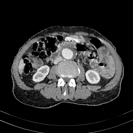 Abdominal aortic aneurysm (Radiopaedia 83581-98689 Axial C+ portal venous phase 59).jpg